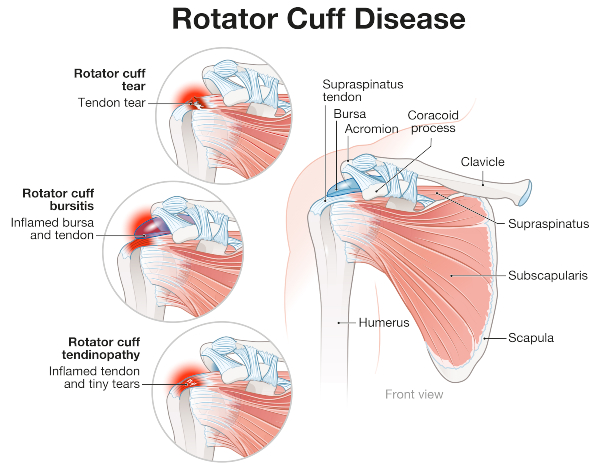ROTATOR CUFF TEAR - Midwest Orthopaedics