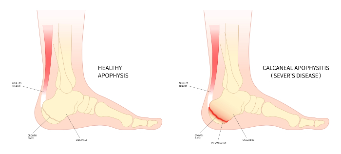 Navicular stress fractures – symptoms and treatment