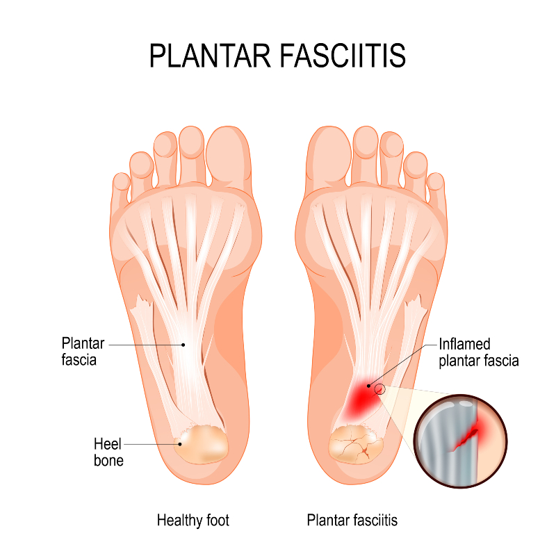 Calcaneal Heel Spur Treatment | Foot Heel Spur Pain Relief