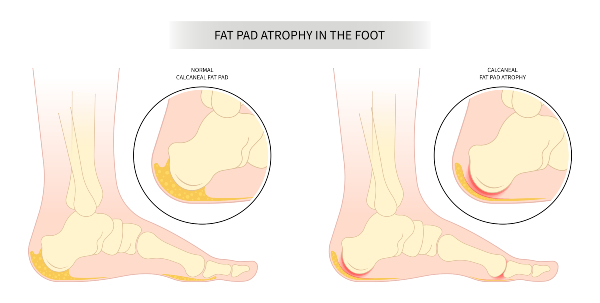 Common Foot Problems and How to treat? | ACC